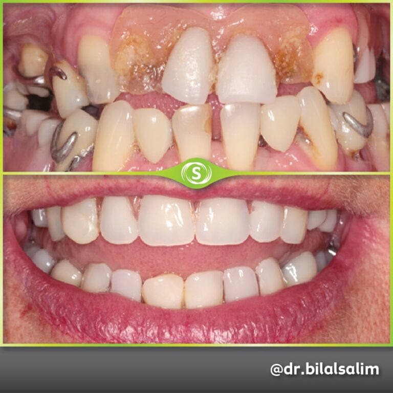 Composite Bonding, Valplast Denture and Teeth Whitening - Dr. Bilal Salim