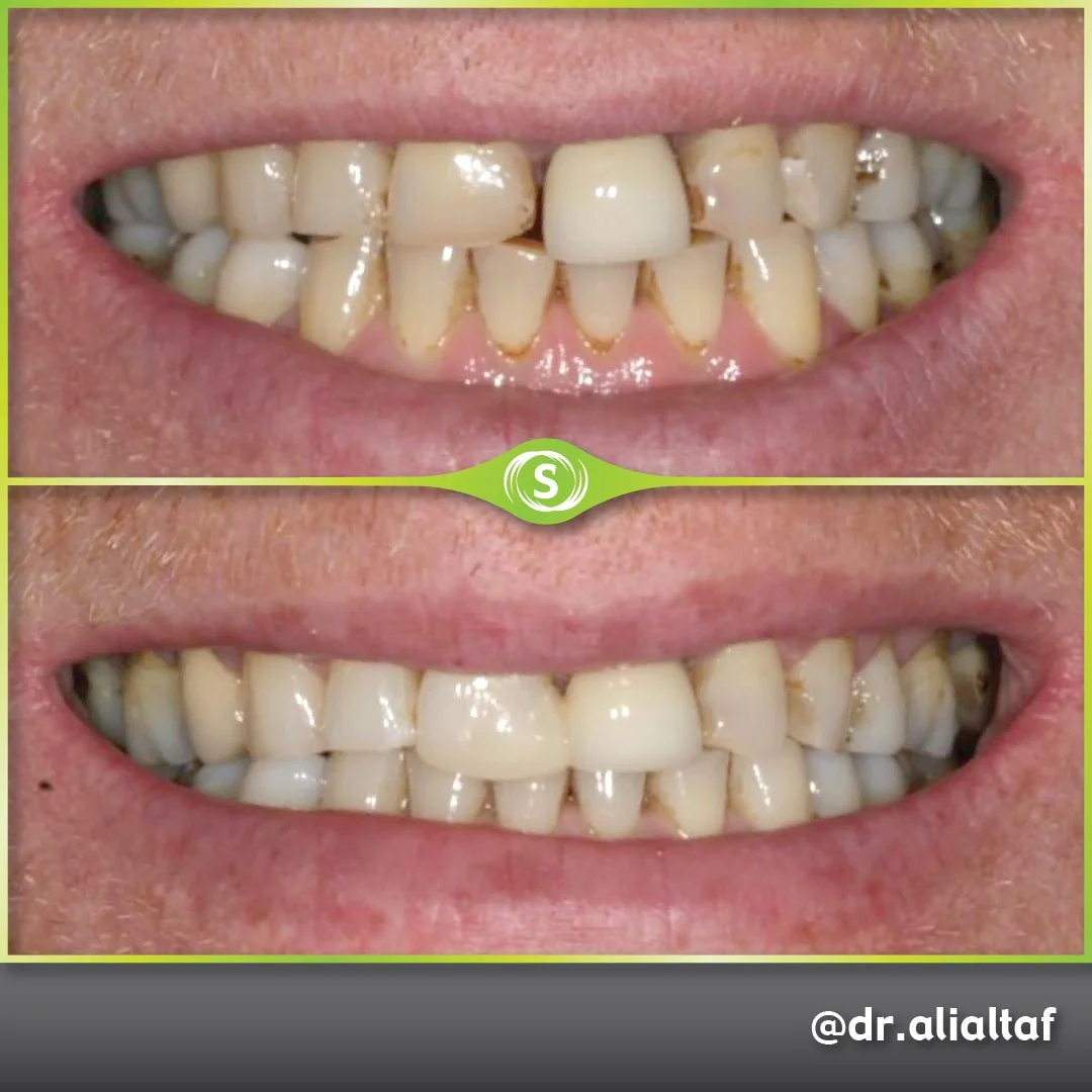 Composite Bonding - Dr. Ali Altaf