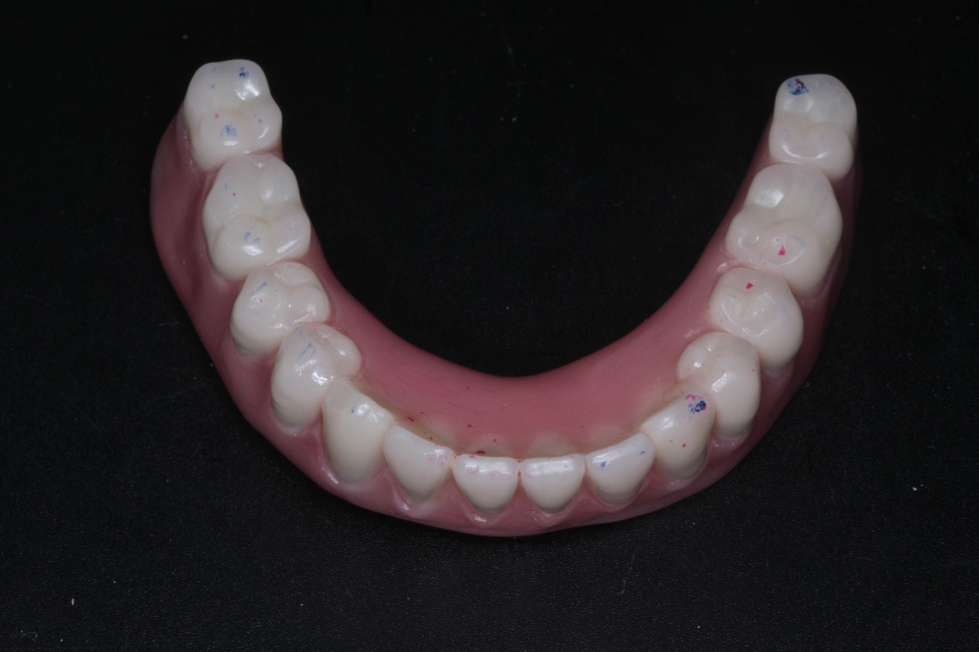 Case Study Do Your Dentures Make You Feel Insecure Synergy Dental Clinics