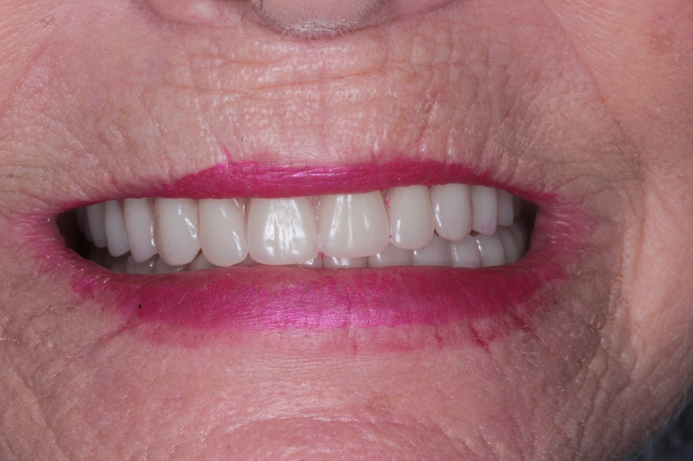 Case Study Do Your Dentures Make You Feel Insecure? • Synergy Dental