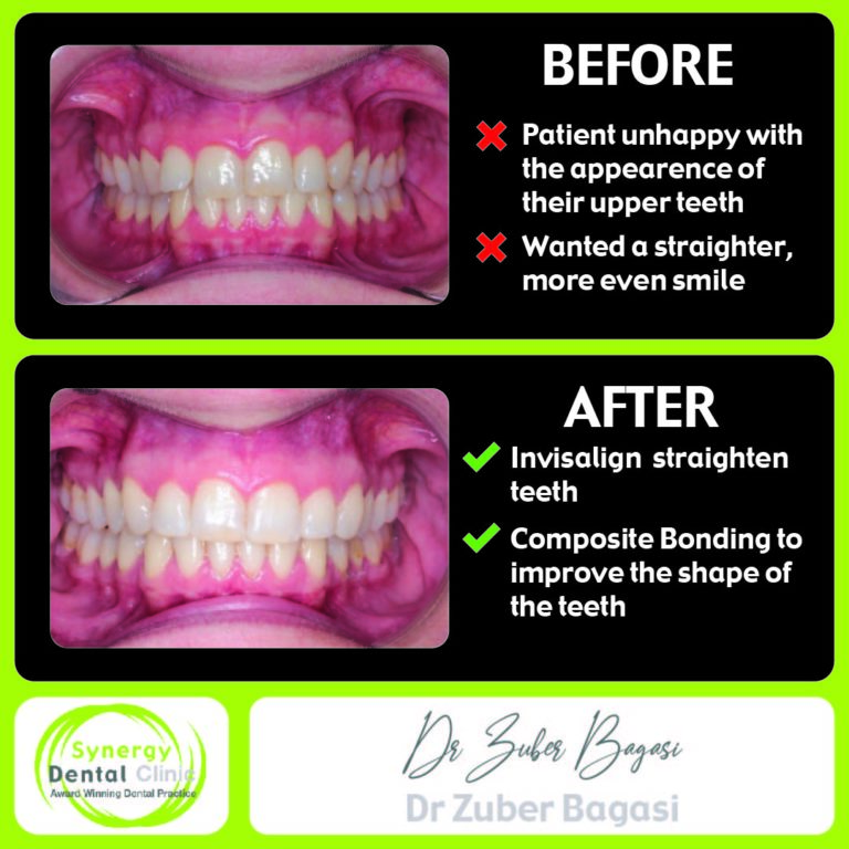 InvisalignⓇ Clear Braces Case 12 • Synergy Dental Clinics