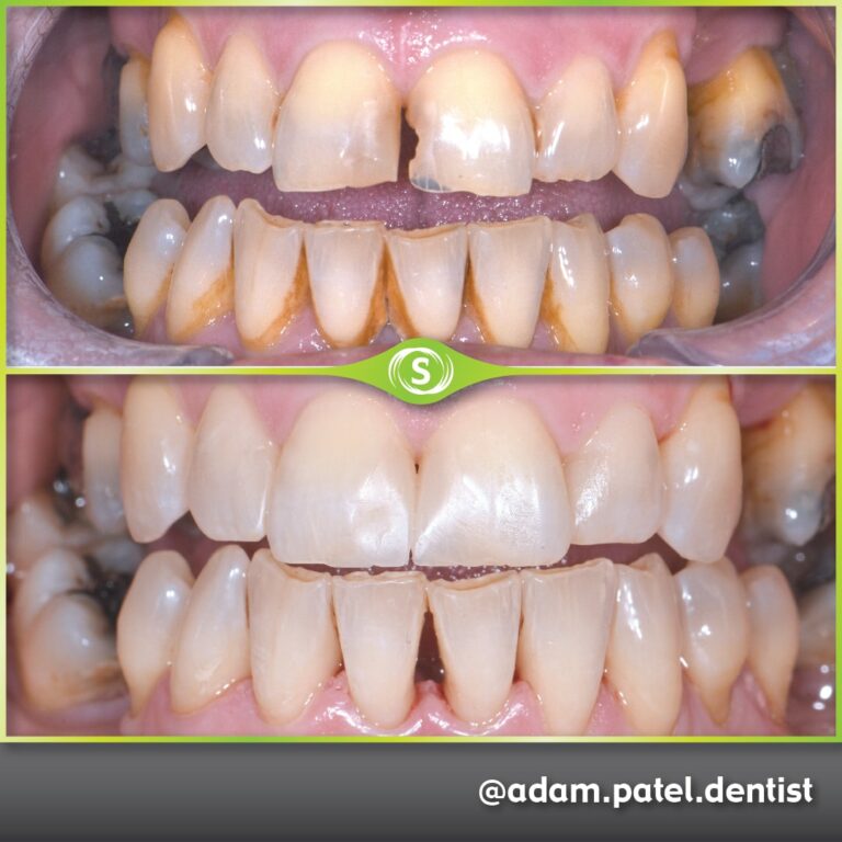Cosmetic Dentistry - Dr. Adam Patel