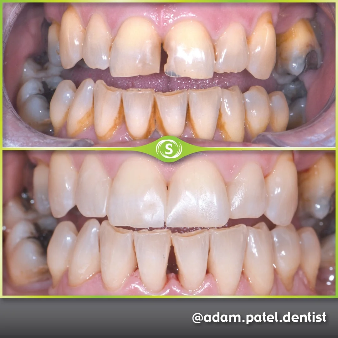 Cosmetic Dentistry - Dr. Adam Patel