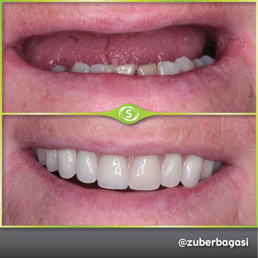 B&A FSD Implants ZB-min (1)