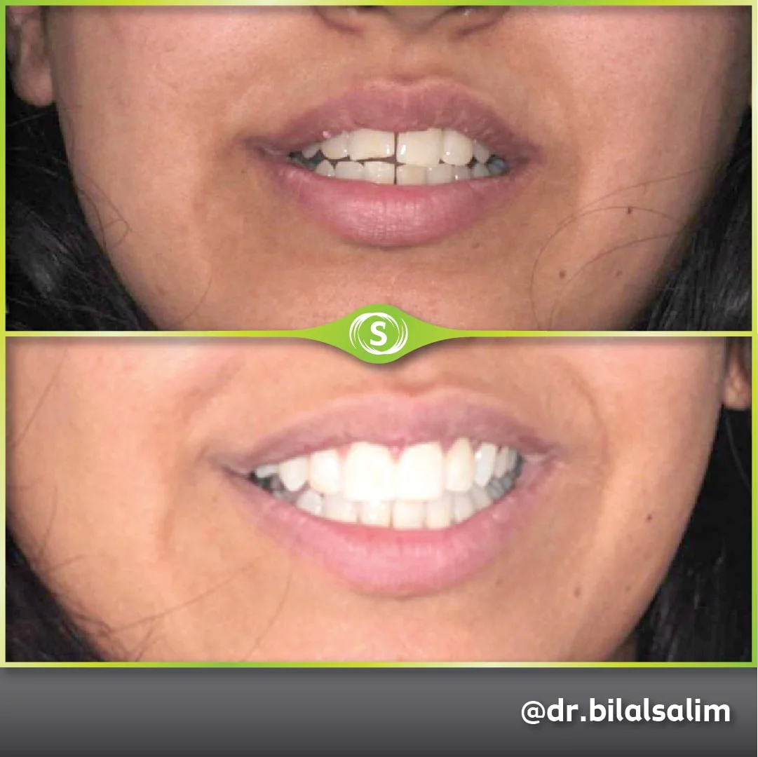 B&A Invisalign BS 1-min