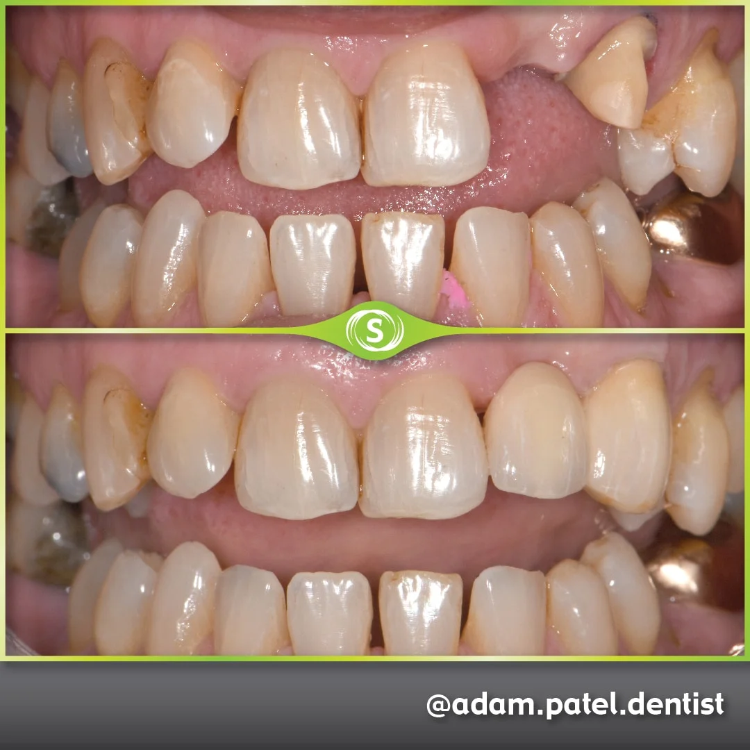 Cosmetic Dentistry - Zirconia Bridge - Dr. Adam Patel