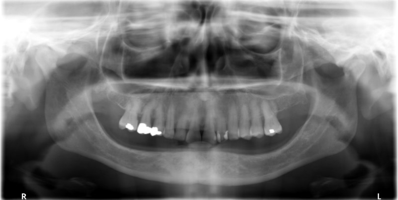 X-ray missing teeth