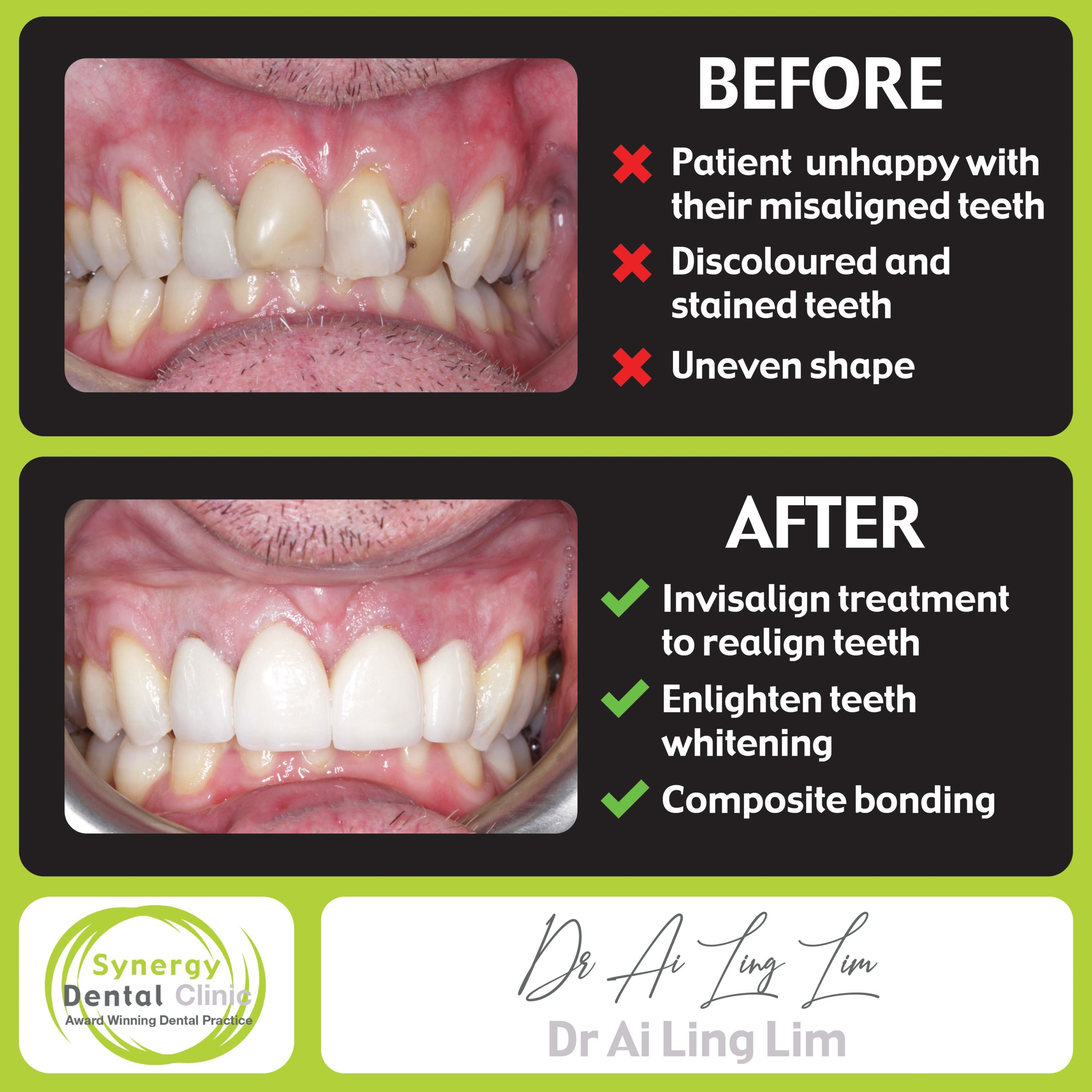 bonding • Synergy Dental Clinics