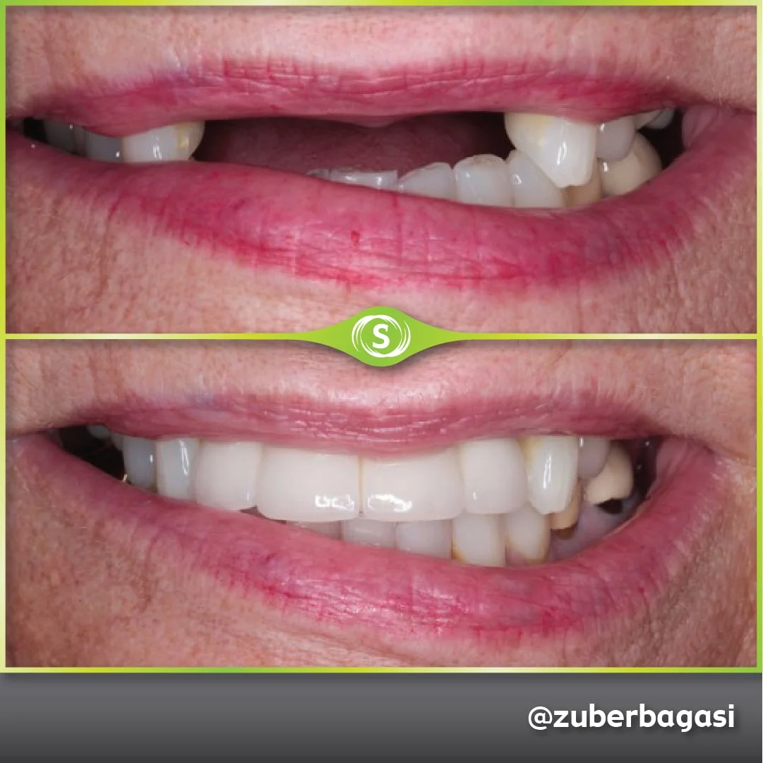 B&A Implants ZB 1-min