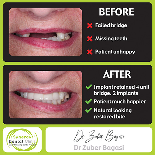 Implant Retained 2 Implants, 4Unit Bridge Case Study • Synergy