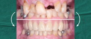17 - Implant Case Study My Teeth Are Rotting Away