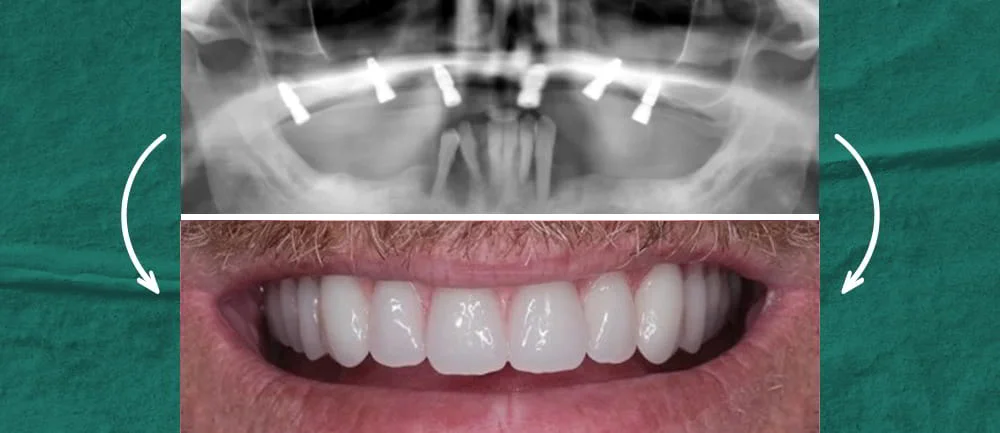 19 - Case Study Fixing Your Smile with Implants!