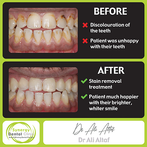 Stain Removal Composite Bonding • Synergy Dental Clinics