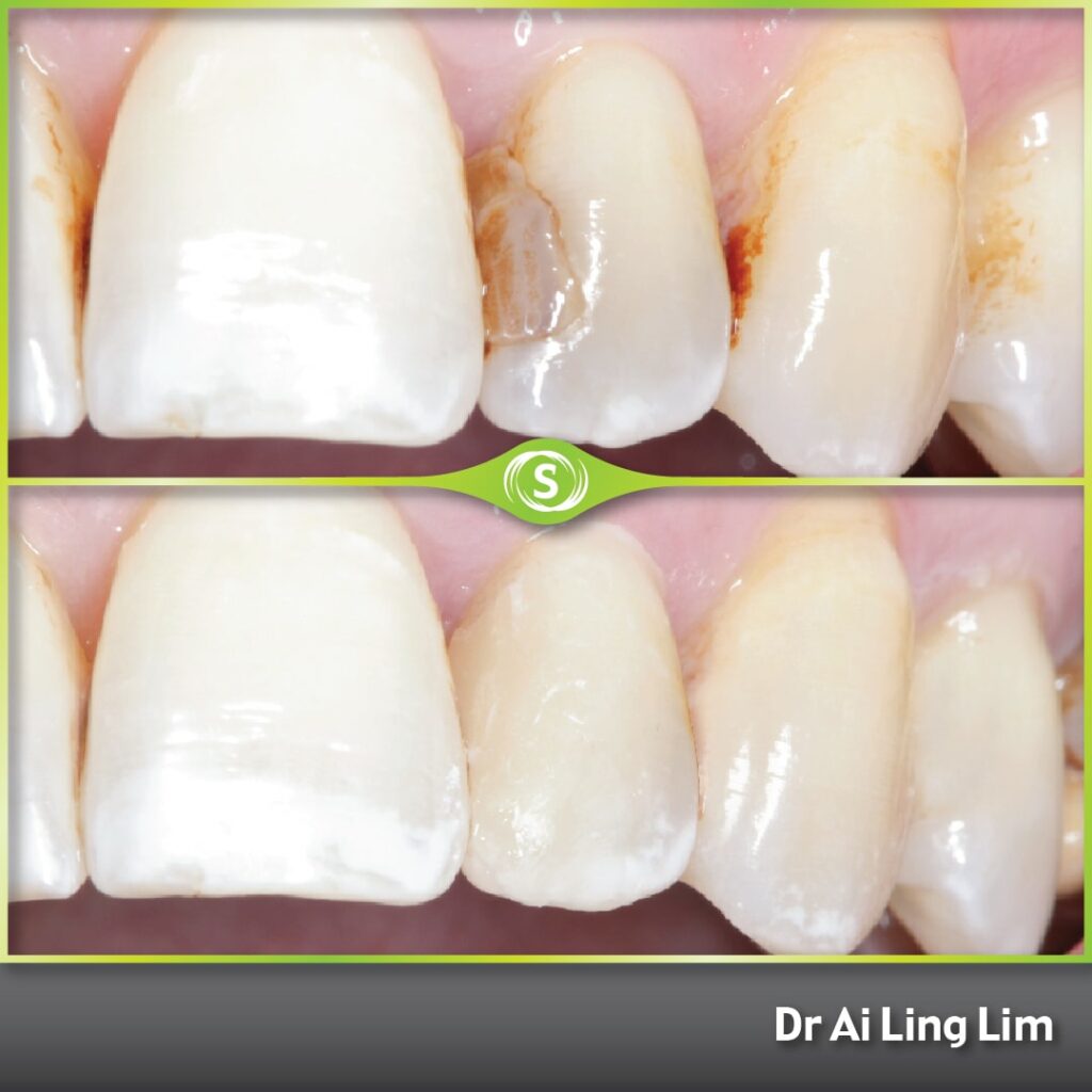 Composite Bonding - Dr. Ai Ling Lim
