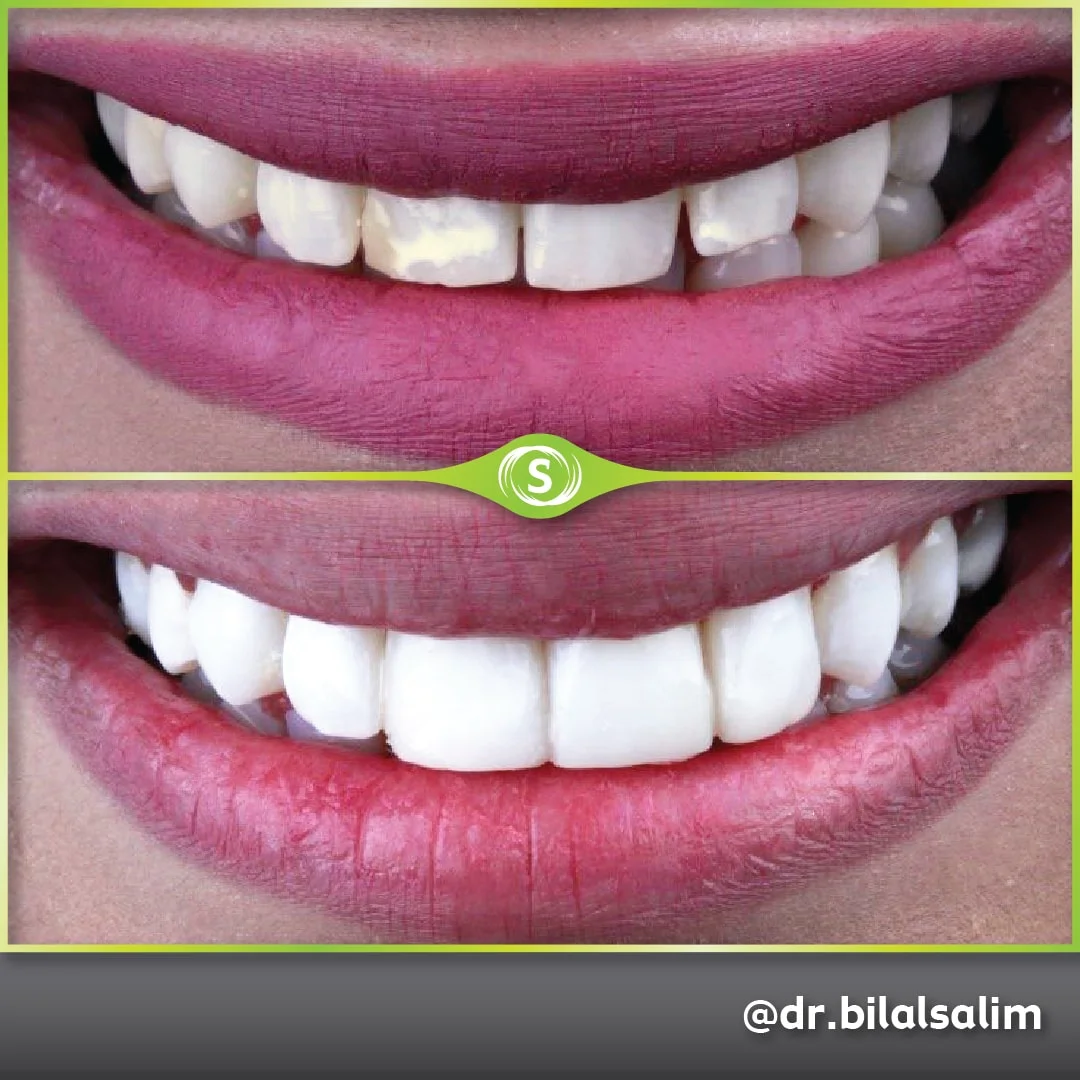 Composite Bonding - Dr. Bilal Salim