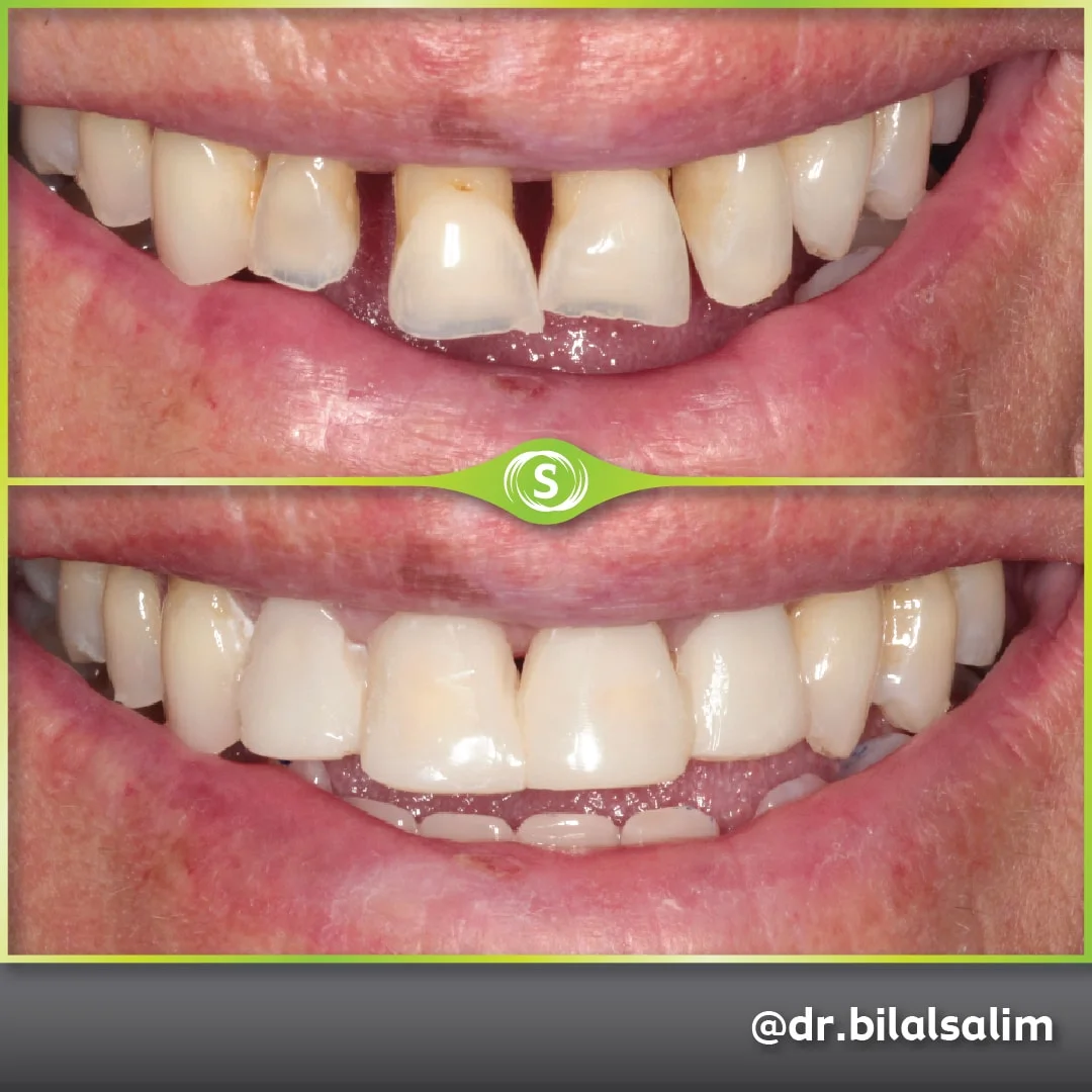 Composite Bonding - Dr. Bialal Salim