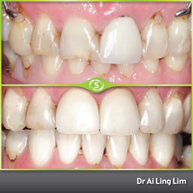 Composite Bonding Crowns and Valplast Partial Denture Dr. Ai Ling Lim