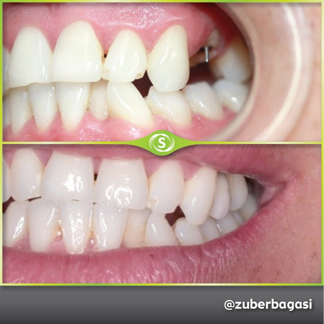B&A Implant - Dr. Zuber Bagasi
