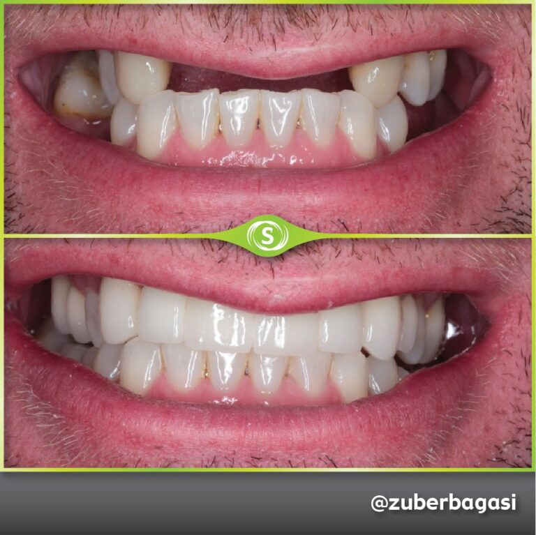 https://synergydental.org.uk/before-and-after/dental-implants/