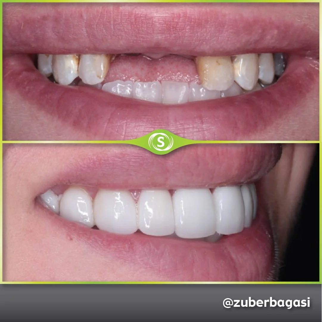 Dental Implants Case - Dr. Zuber Bagasi