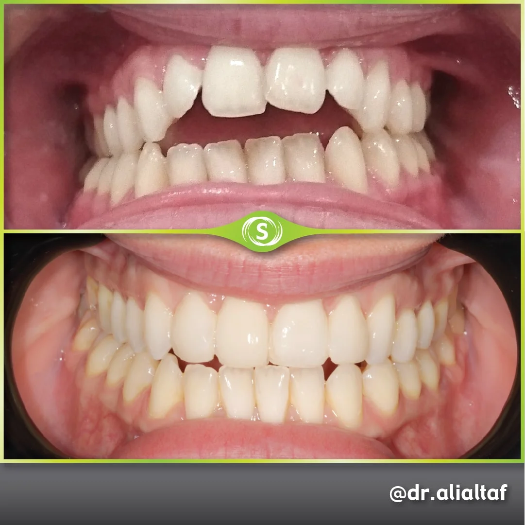 B&A Invisalign AliAltaf 1-min