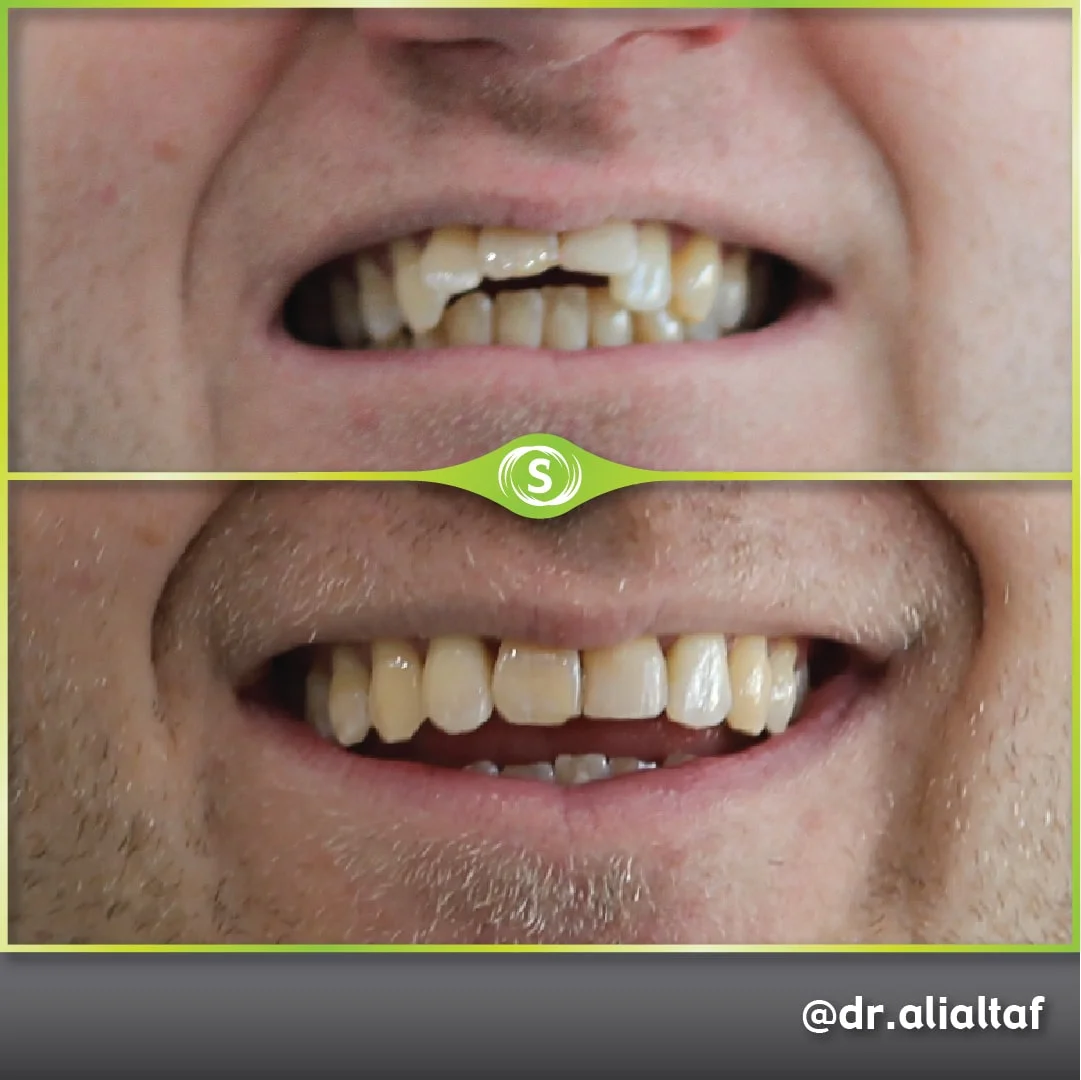 B&A Invisalign AA 2-min