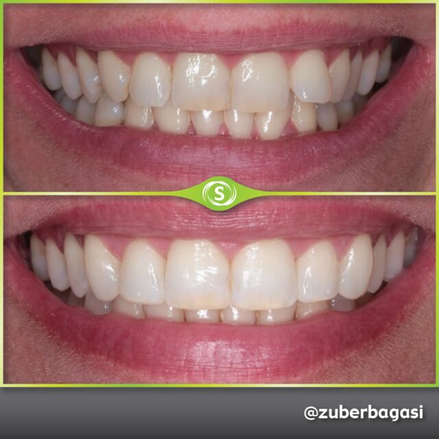 Case Study Teeth Straightening • Synergy Dental Clinics