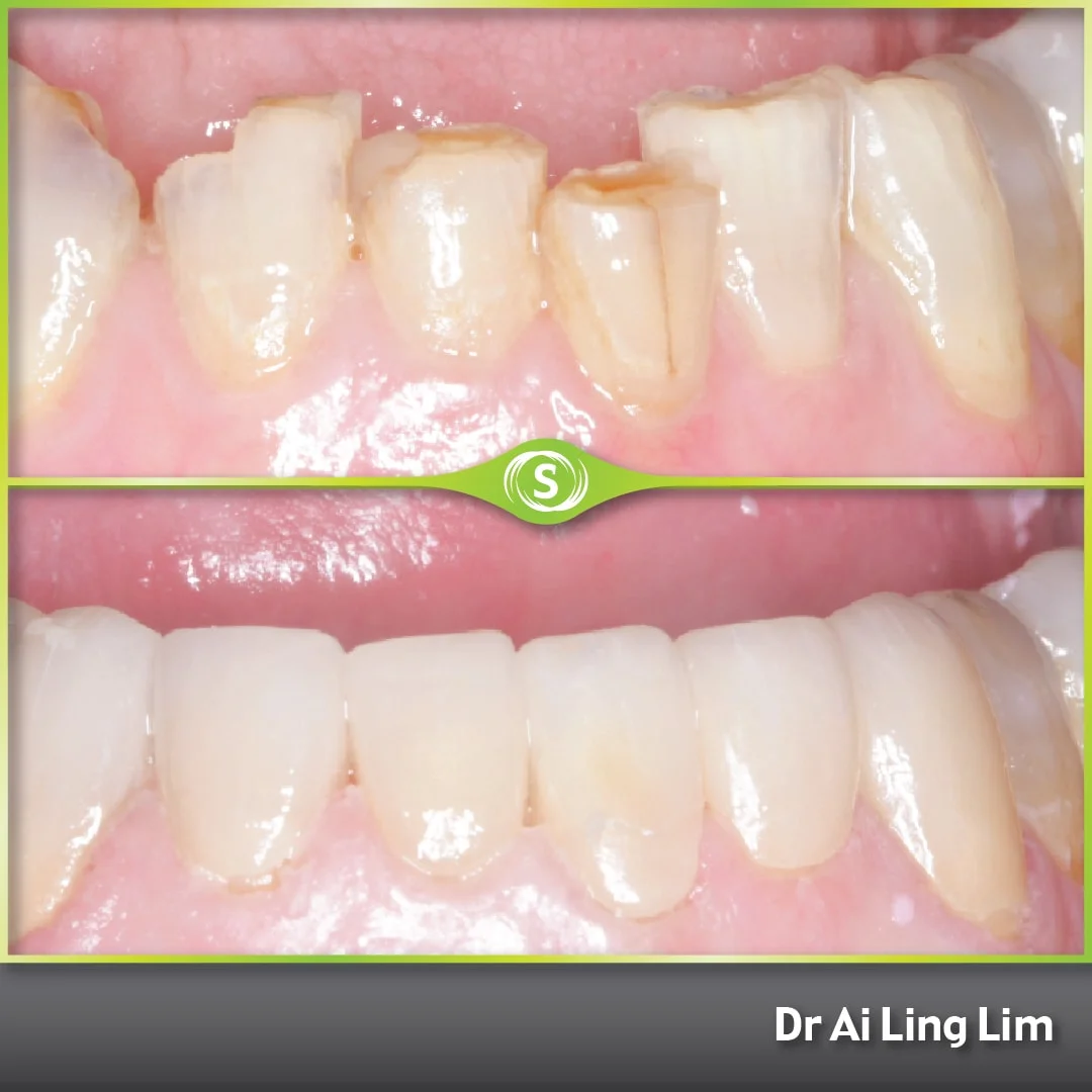 Cosmetic Makeover - Veneers - Dr. Ai Ling Lim