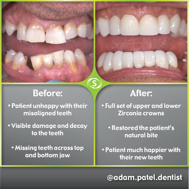 Cosmetic Dentistry - Zirconia Crowns - Dr. Adam Patel