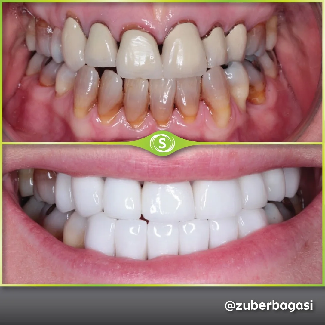 B&A Zirconia Crowns ZB 1a-min