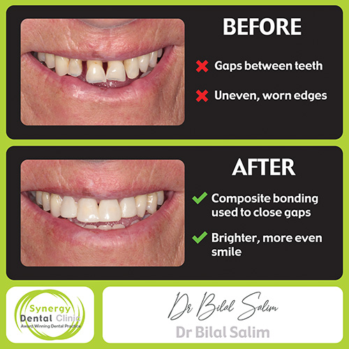 Before and After Composite Bonding Cases • Synergy Dental Clinics