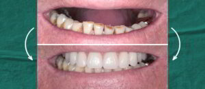 13 - Case Study New Teeth with Full-Arch Implants