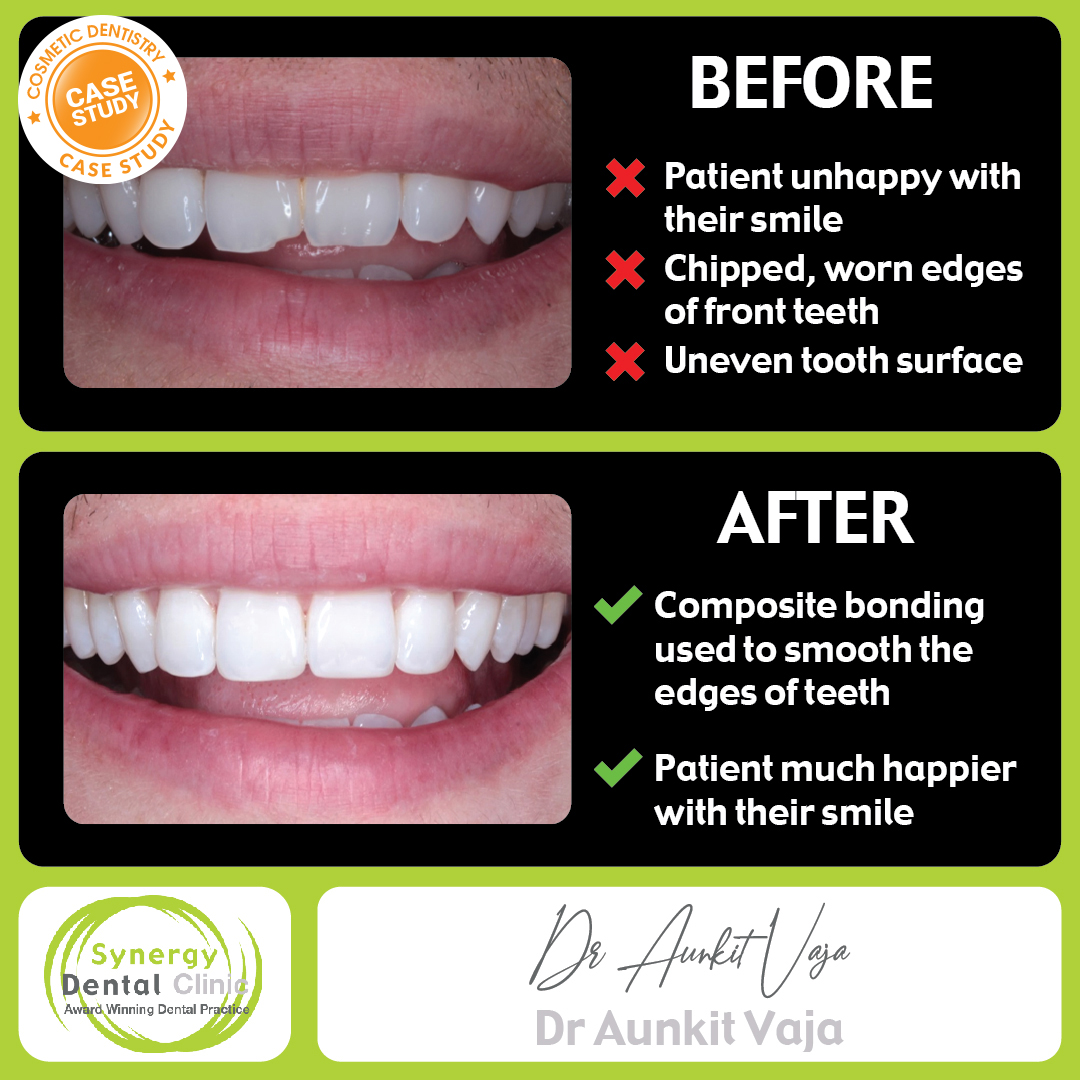 Cosmetic Case Study Composite and More! • Synergy Dental Clinics