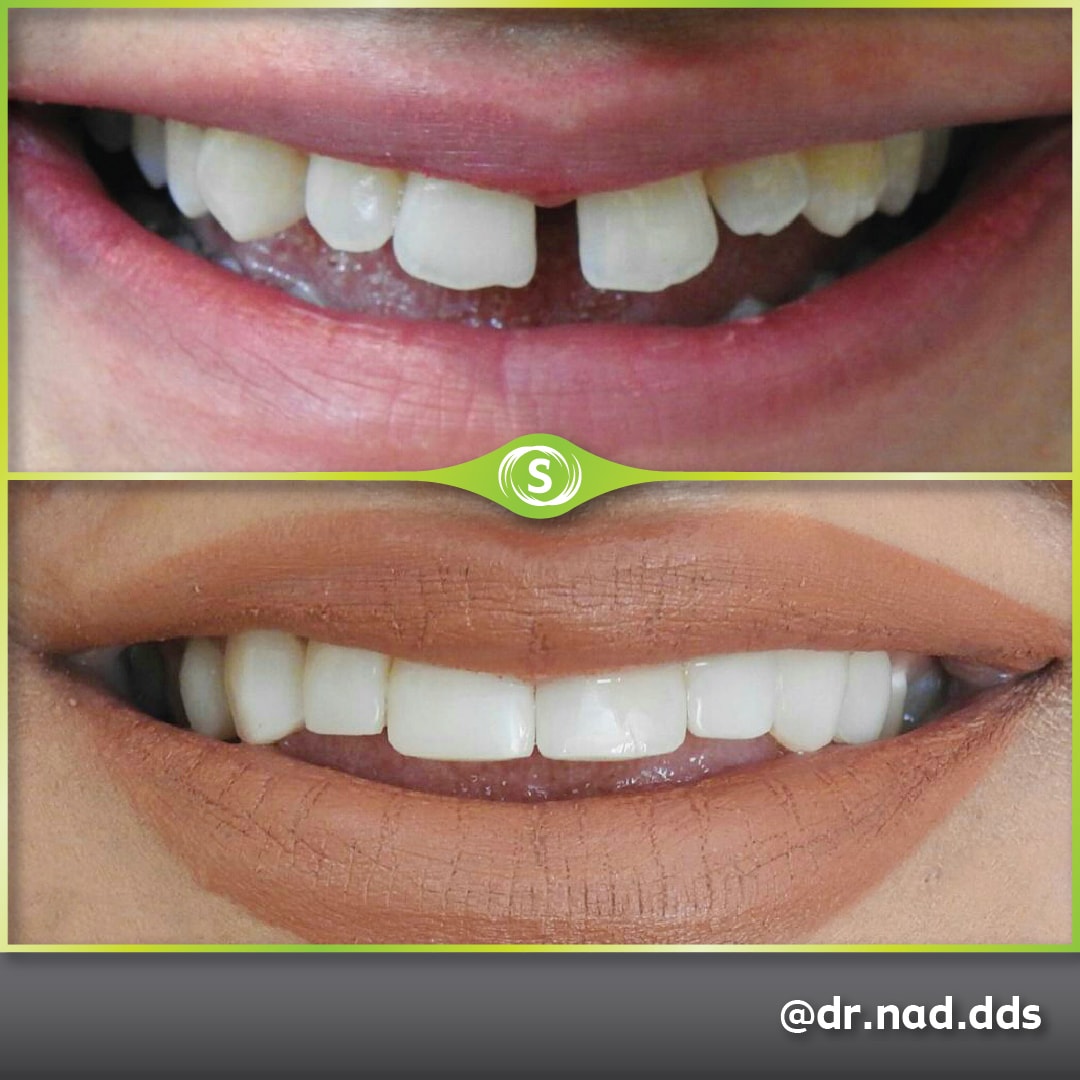 Composite bonding before and after @dr.nad.dds