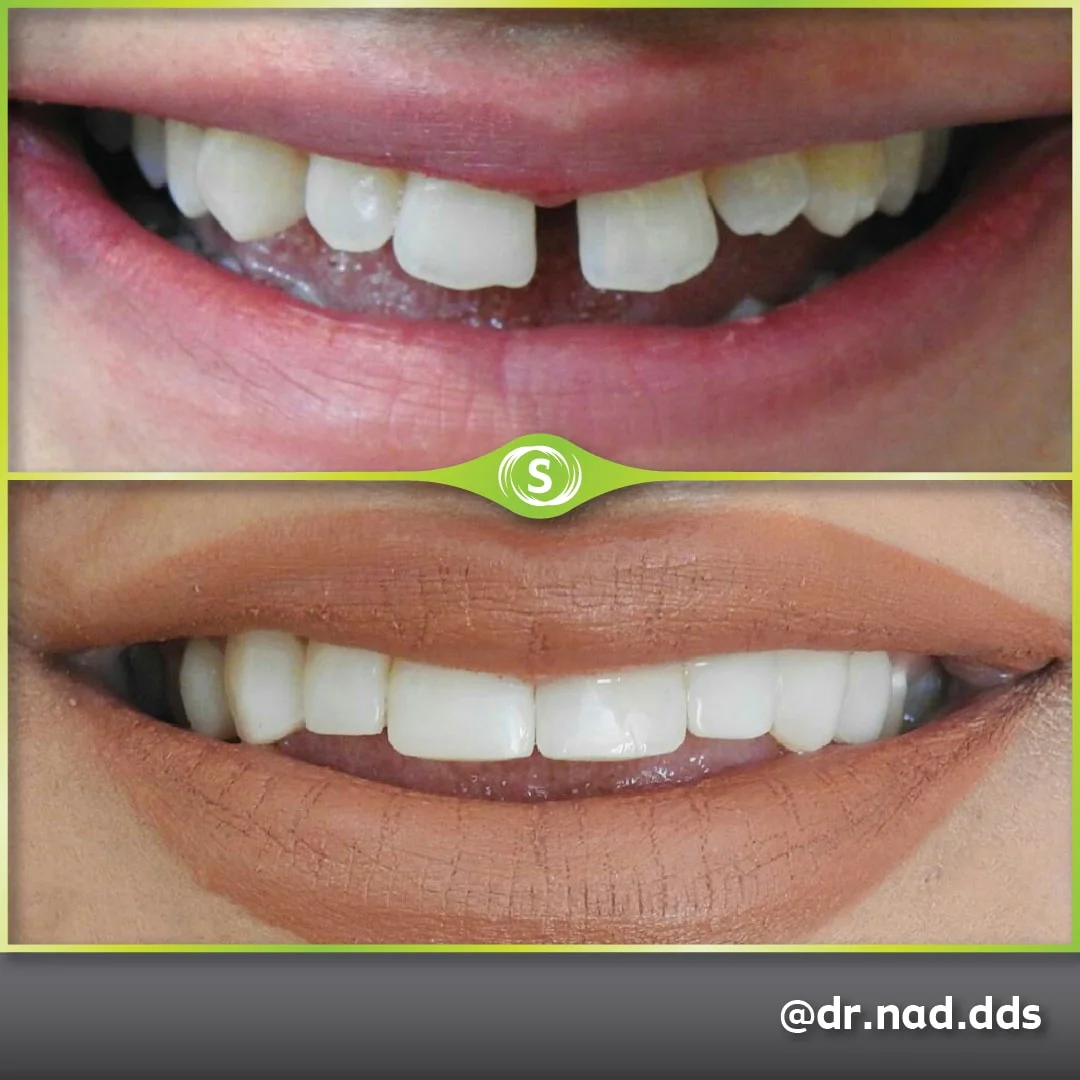 Composite Bonding - Dr. Nader Modarres