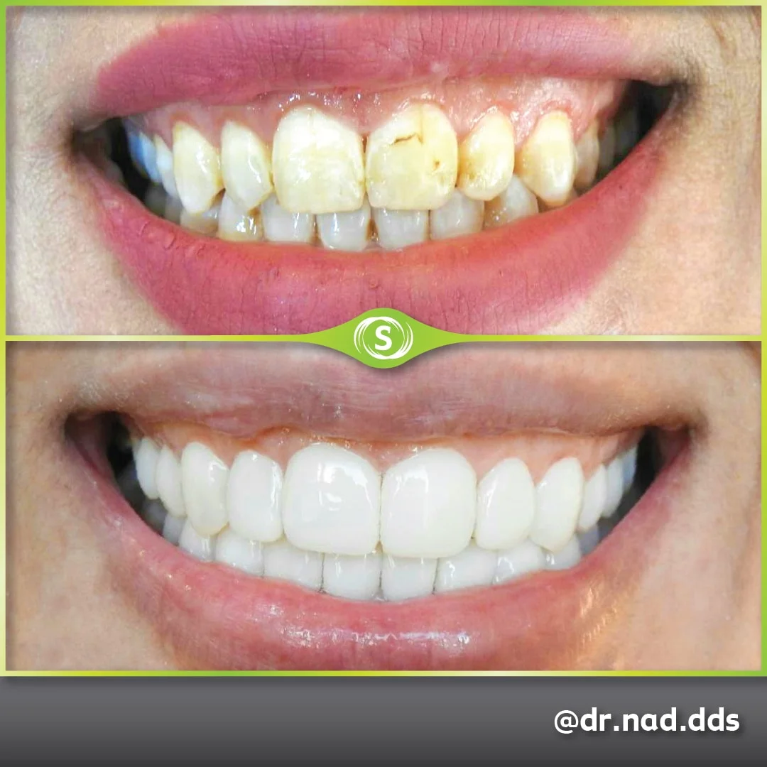 Composite Bonding - Dr Nader Modarres