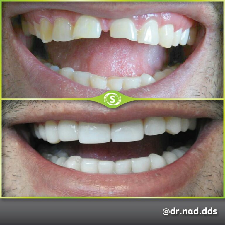 Cosmetic Dentistry Composite Bonding 80 - Dr. Nader Modarres