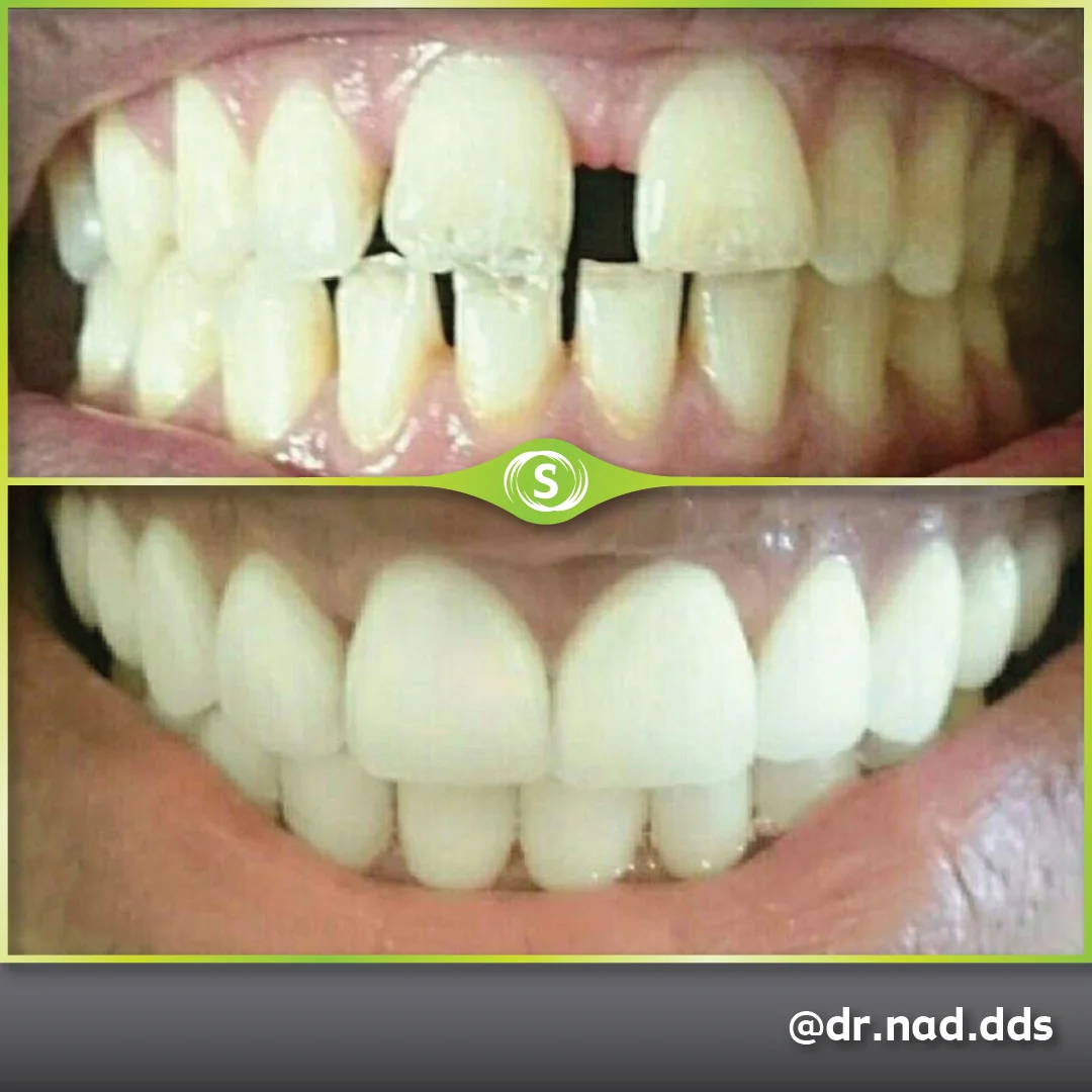 Cosmetic Dentistry - Porcelain Veneers - Dr. Nader Modarres