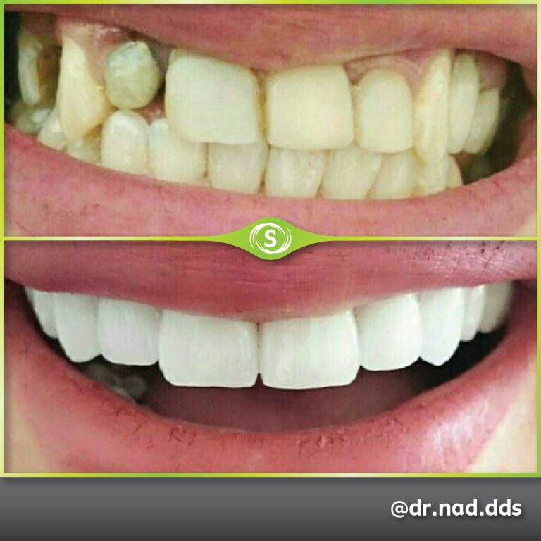 Cosmetic Dentistry - Zirconia Bridge - Dr. Nader Modarres