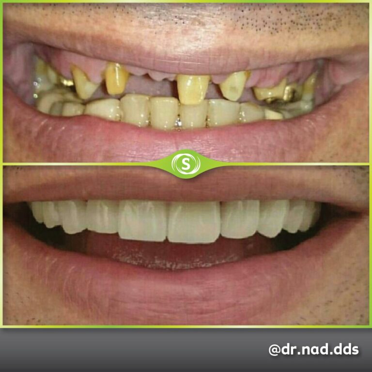 Dental Bridge E-max Zirconia - Dr. Nader Modarres