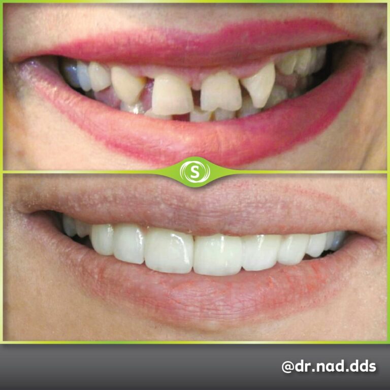 Dental Bridge - Dr. Nader Modarres
