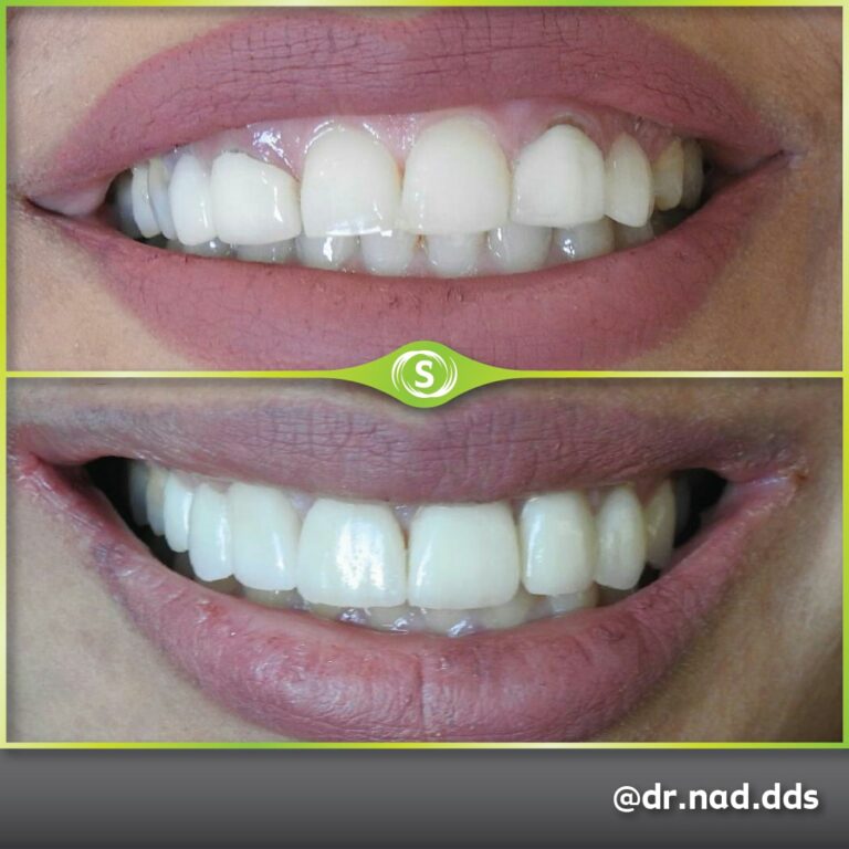 Dental Crown Zirconia E-max - Dr. Nader Modarres