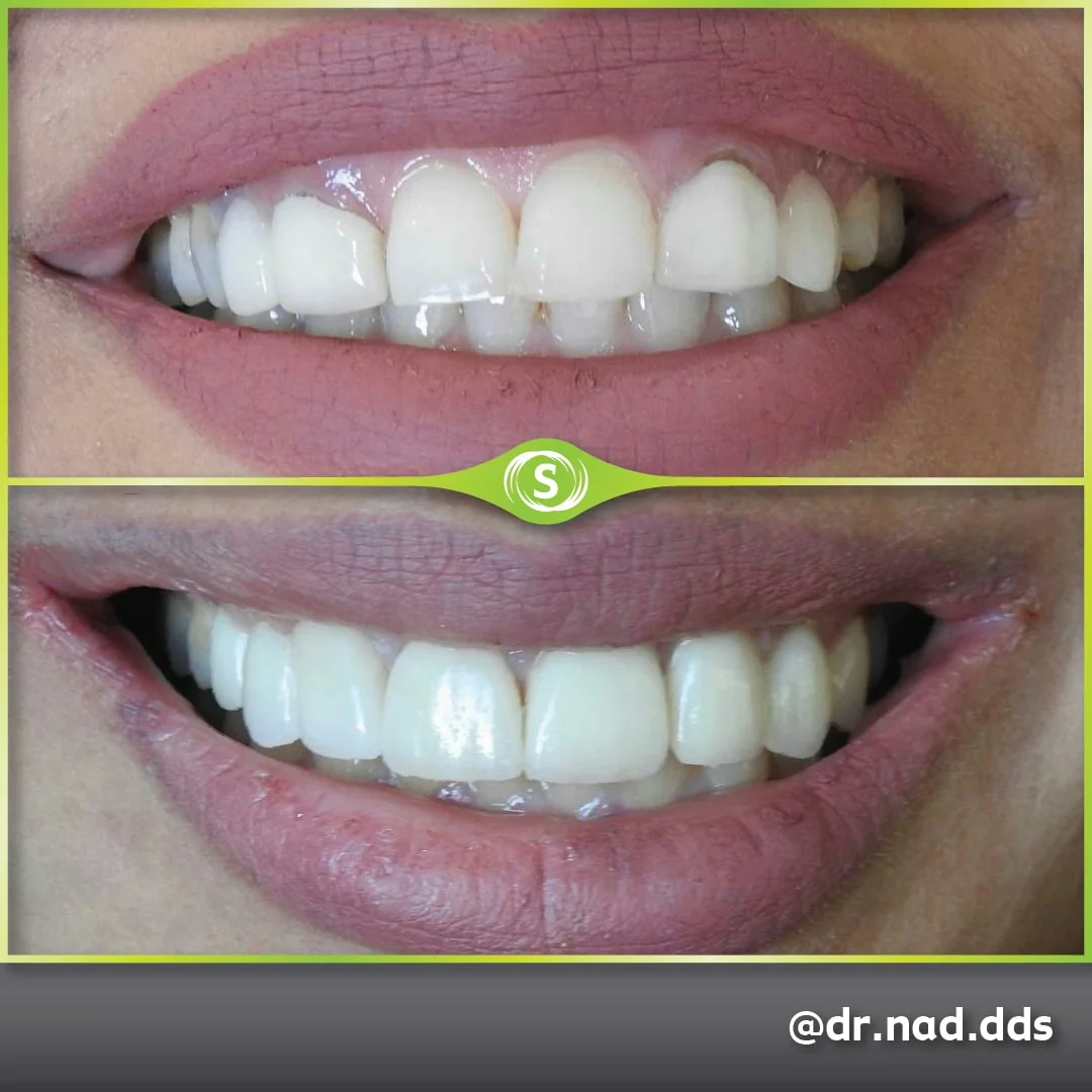 Dental Crown Zirconia E-max - Dr. Nader Modarres