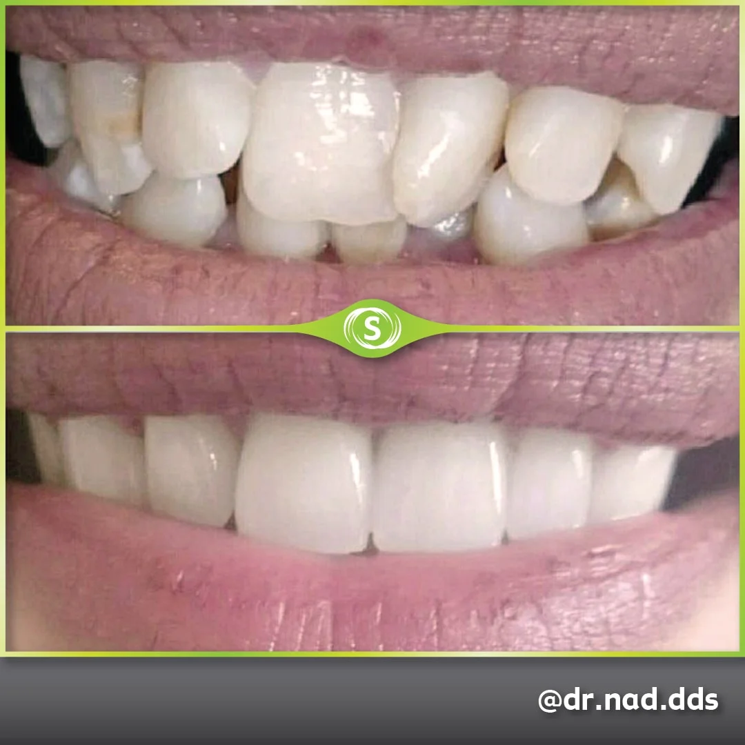 Dental Crowns Zirconia E-max - Dr. Nader Modarres