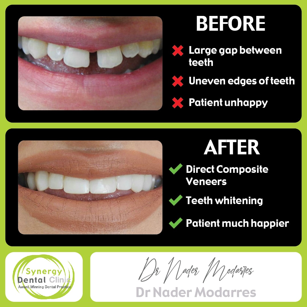 Cosmetic Dentistry Composite Bonding 77 • Synergy Dental Clinics