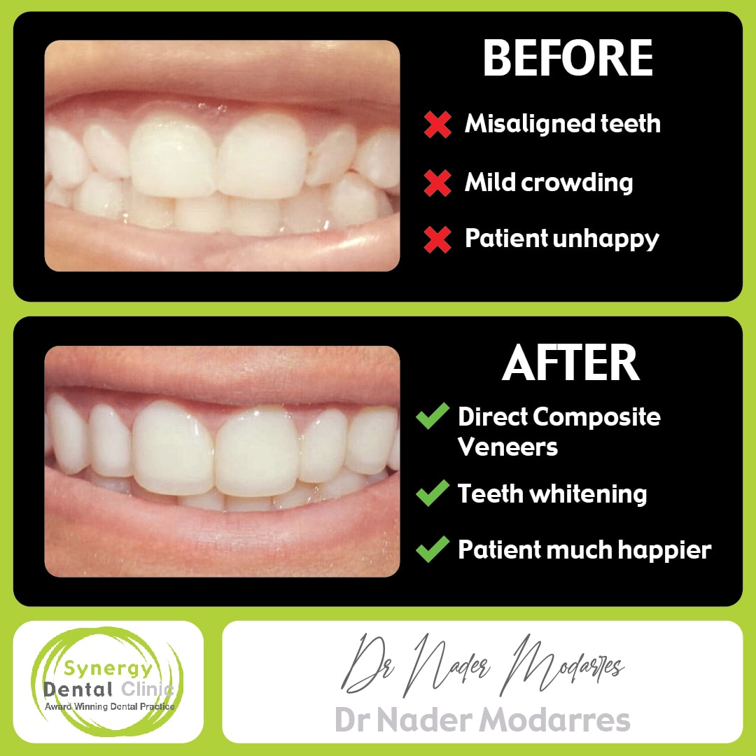 Cosmetic Dentistry Composite Bonding 78 • Synergy Dental Clinics