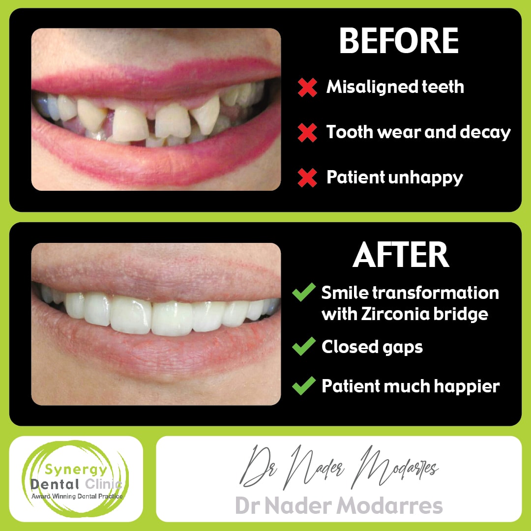 Cosmetic Dentistry Zirconia Bridge 2 • Synergy Dental Clinics