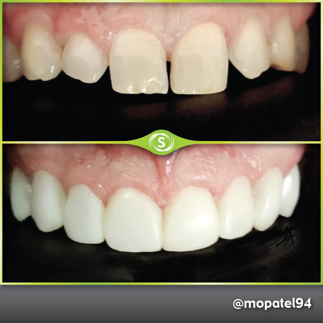 Composite Bonding - Dr. Mo Patel