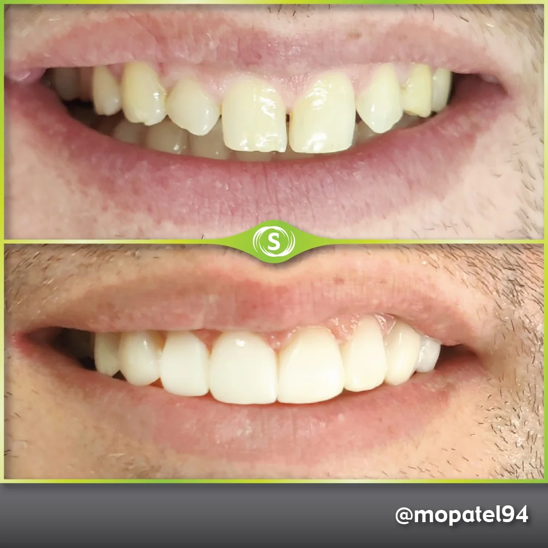 Composite Bonding - Dr. Mo Patel