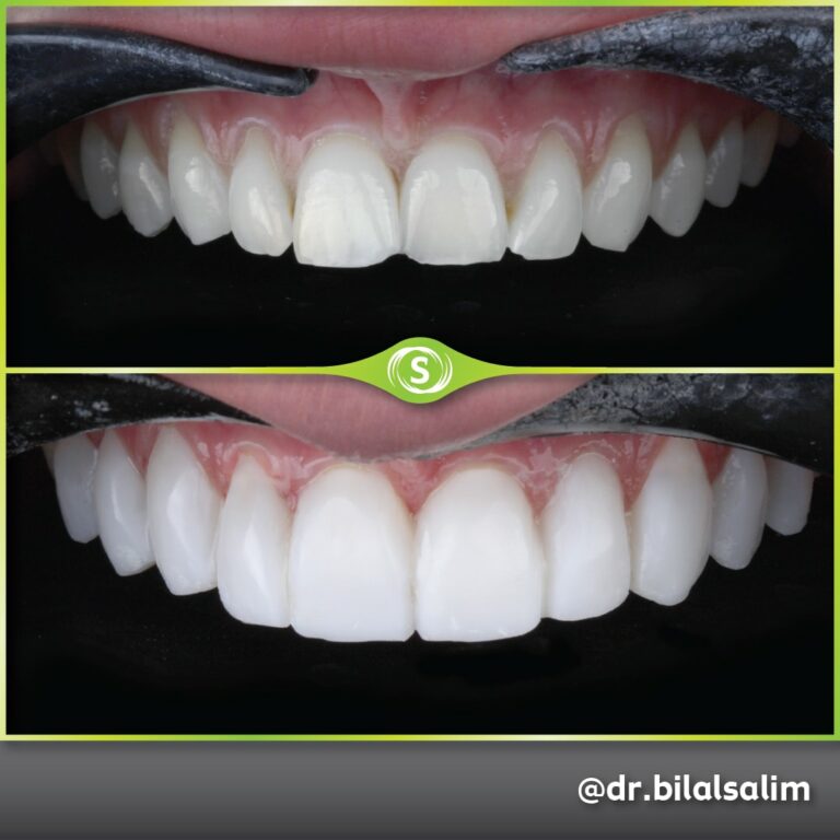 Composite Bonding - Dr. Bilal Salim